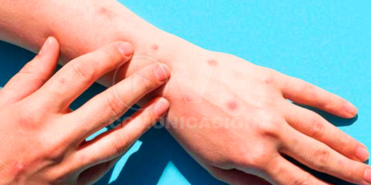 Federación Médica Ecuatoriana y el Ministerio de Salud Pública desmienten un caso de viruela del mono en Ecuador