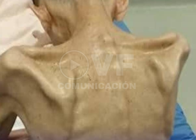 Reo de Esmeraldas que sufrió desnutrición y anemia murió en el Hospital General Delfina Torres