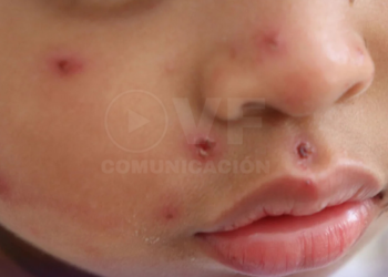 OPS insta a los países de América a incrementar vigilancia ante aumento de casos de sarampión