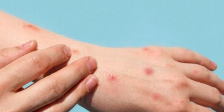 China confirmó cinco casos de la nueva variante de mpox, antes conocida como viruela del mono